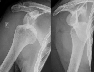 992px-Dislocated_shoulder_X-ray_03