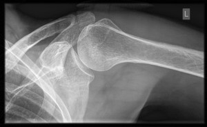 shoulder-xray