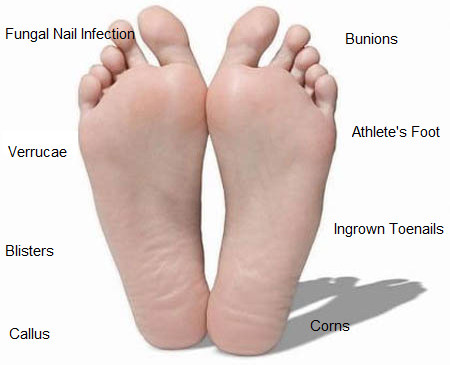 verruca athlete s foot