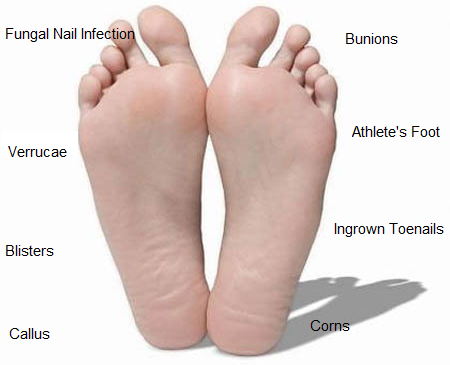 Common Foot Problems