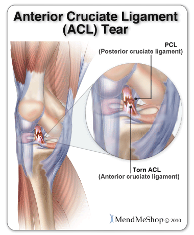 Anterior Cruciate Ligament Injury – A Personal Journey